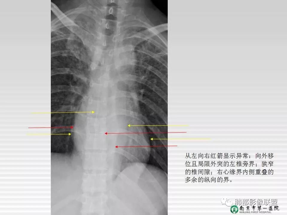 【PPT】胸片中的界与线——识别隐匿者与伪装者