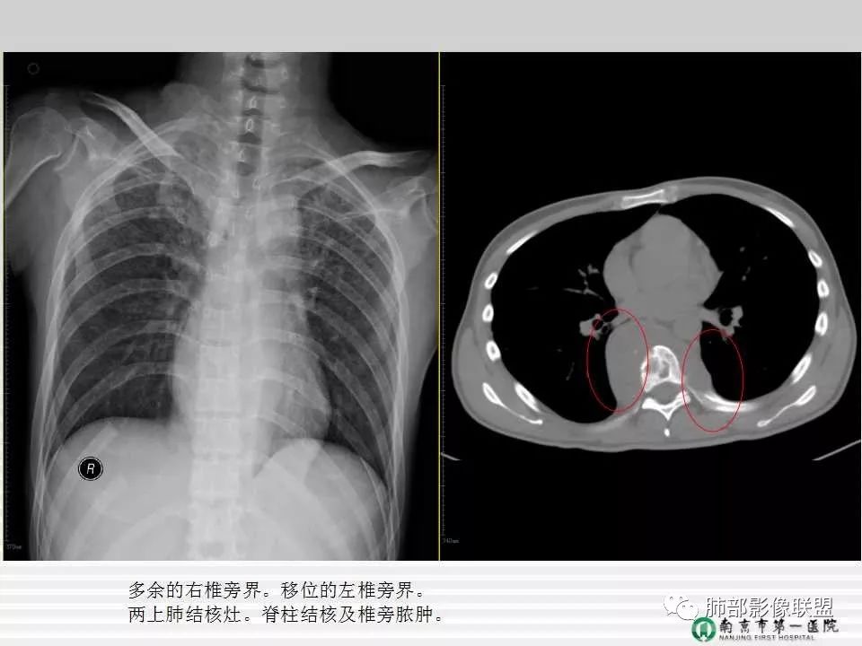 【PPT】胸片中的界与线——识别隐匿者与伪装者