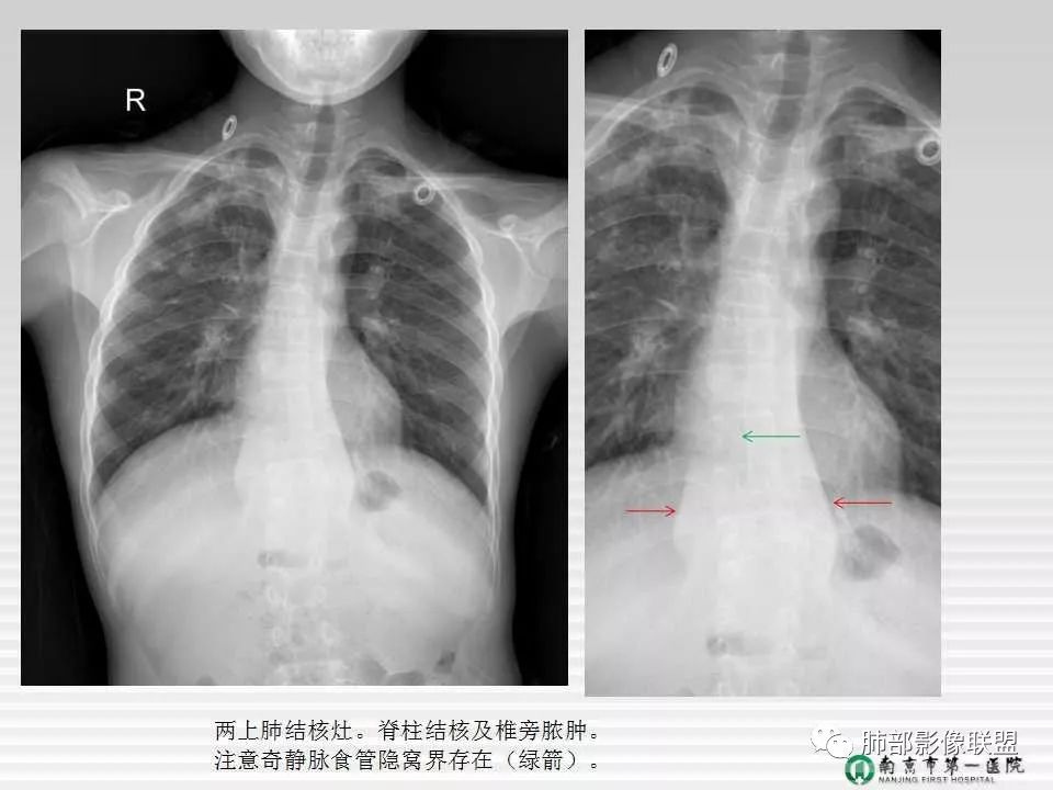 【PPT】胸片中的界与线——识别隐匿者与伪装者
