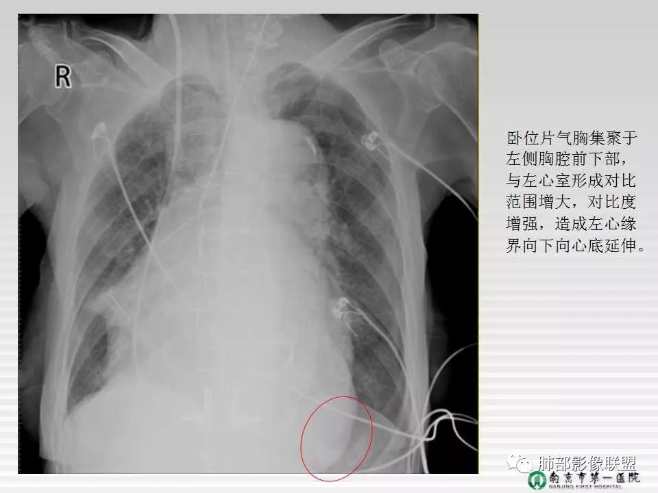 【PPT】胸片中的界与线——识别隐匿者与伪装者