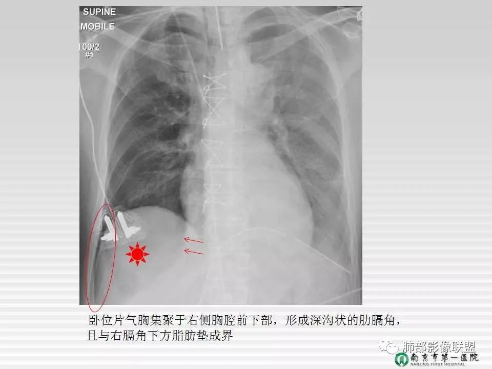 【PPT】胸片中的界与线——识别隐匿者与伪装者