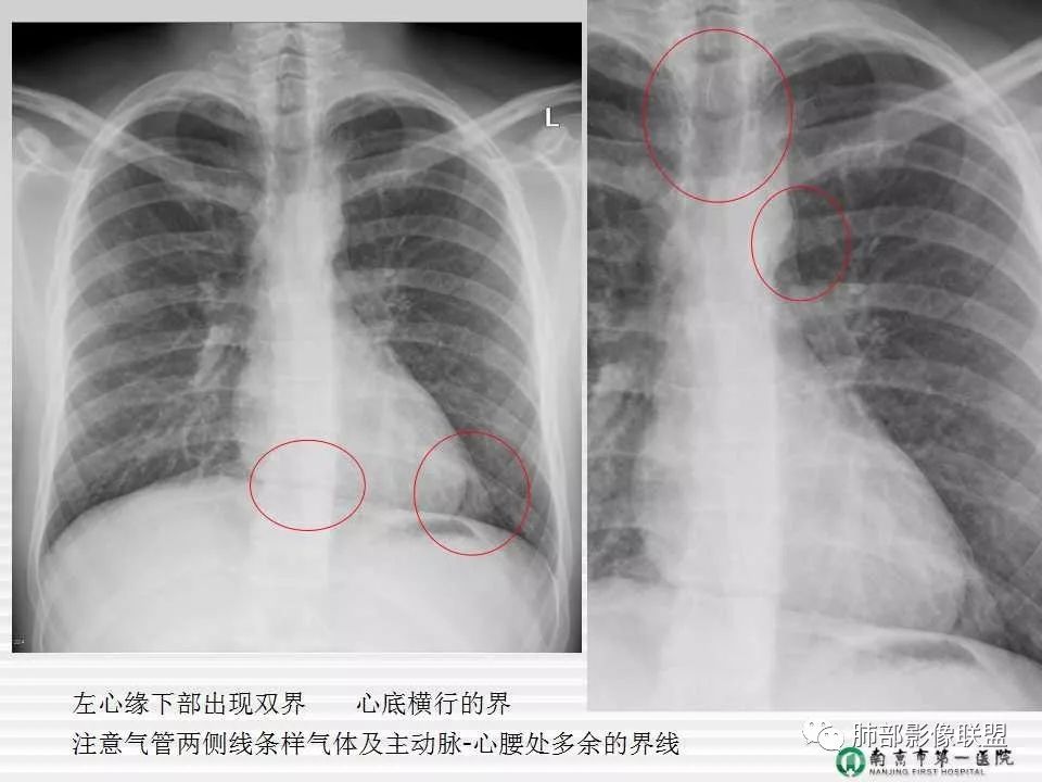 【PPT】胸片中的界与线——识别隐匿者与伪装者