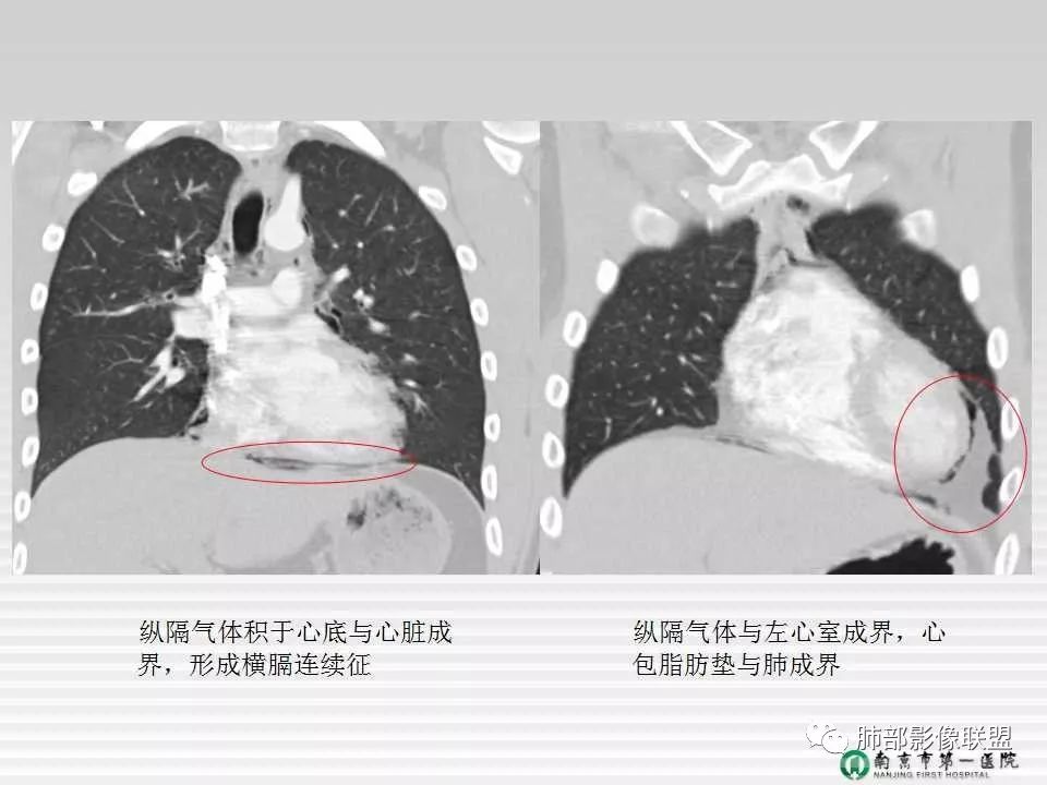 【PPT】胸片中的界与线——识别隐匿者与伪装者