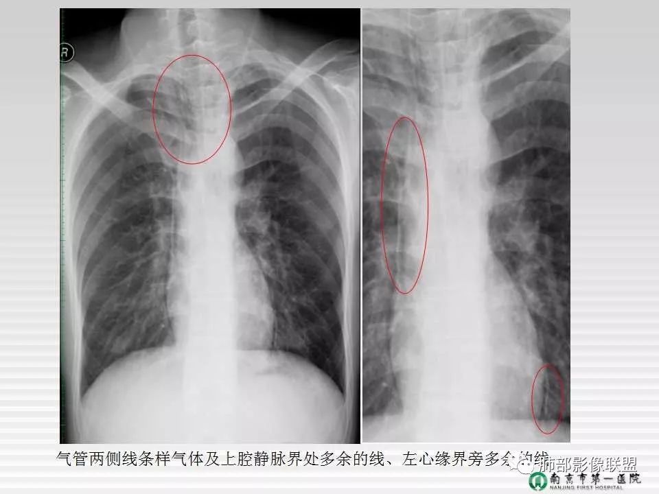 【PPT】胸片中的界与线——识别隐匿者与伪装者