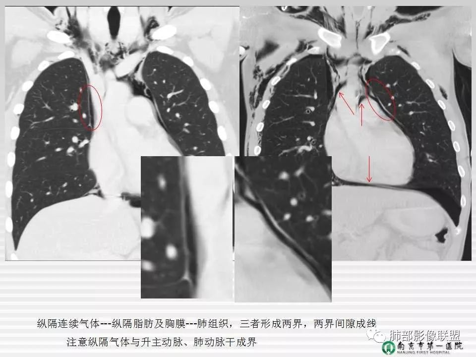 【PPT】胸片中的界与线——识别隐匿者与伪装者