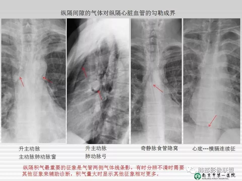 【PPT】胸片中的界与线——识别隐匿者与伪装者