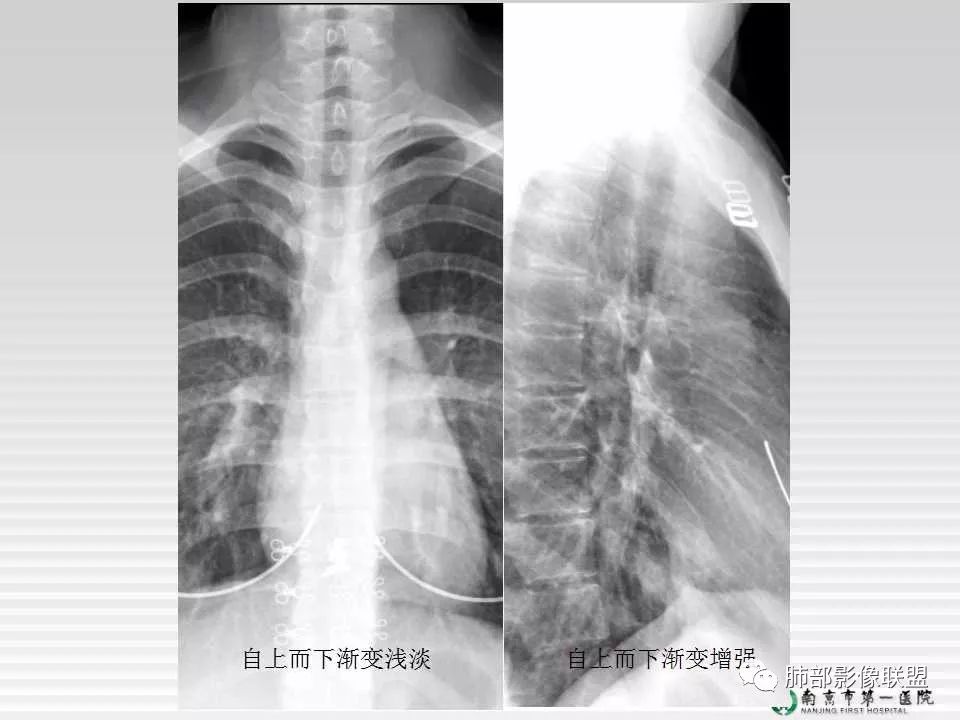 【PPT】胸片中的界与线——识别隐匿者与伪装者