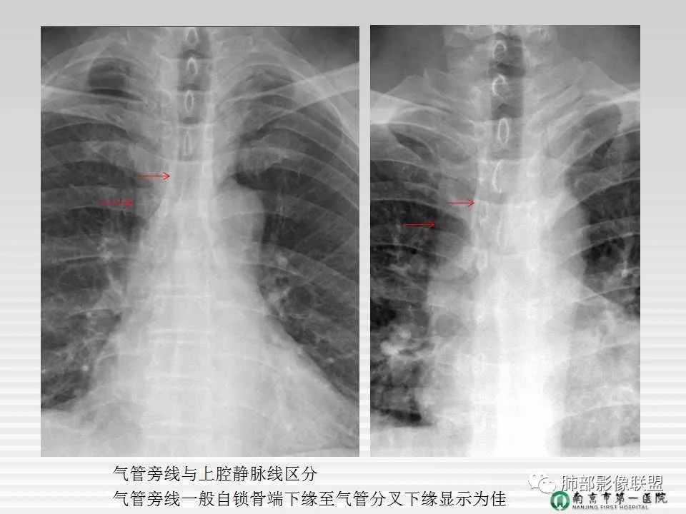 【PPT】胸片中的界与线——识别隐匿者与伪装者