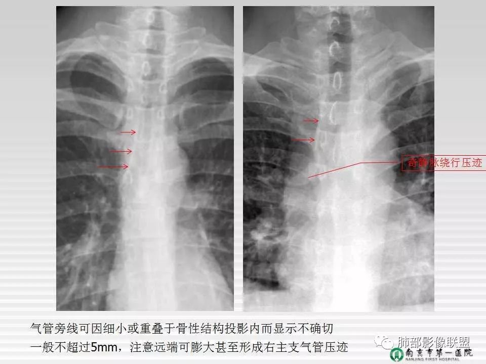 【PPT】胸片中的界与线——识别隐匿者与伪装者