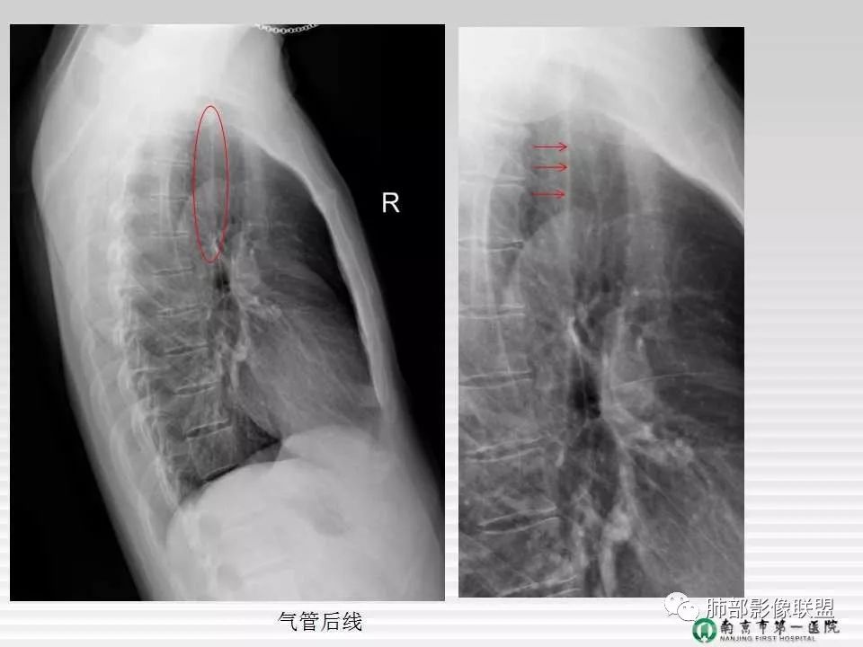 【PPT】胸片中的界与线——识别隐匿者与伪装者