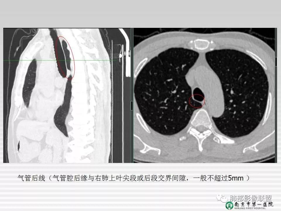 【PPT】胸片中的界与线——识别隐匿者与伪装者