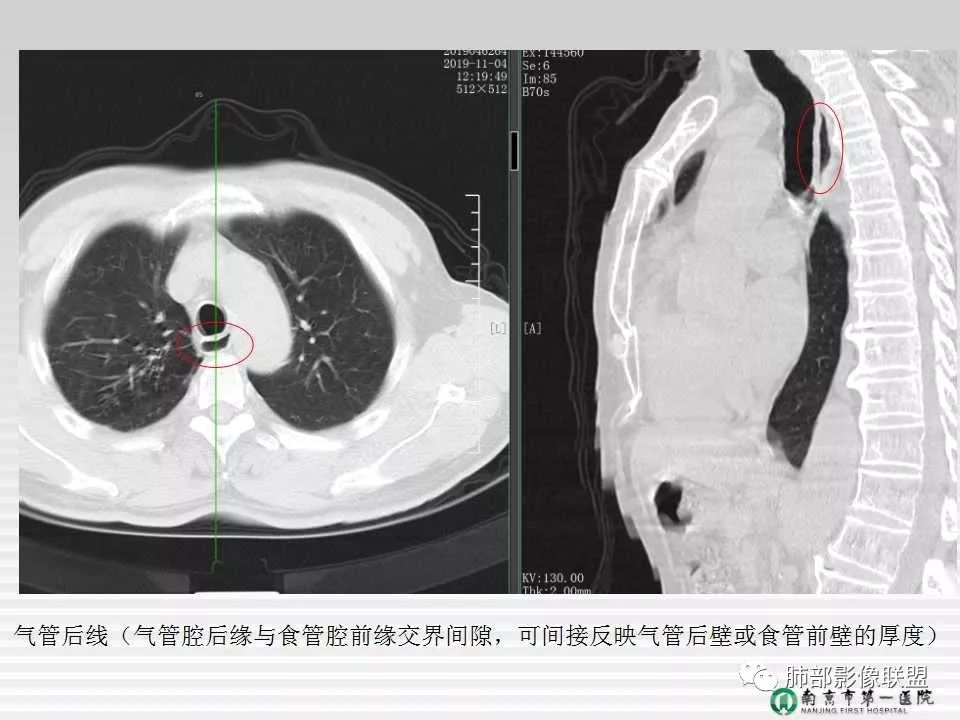 【PPT】胸片中的界与线——识别隐匿者与伪装者