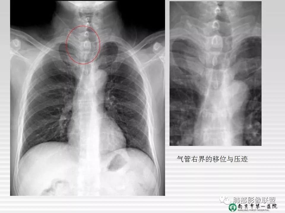 【PPT】胸片中的界与线——识别隐匿者与伪装者