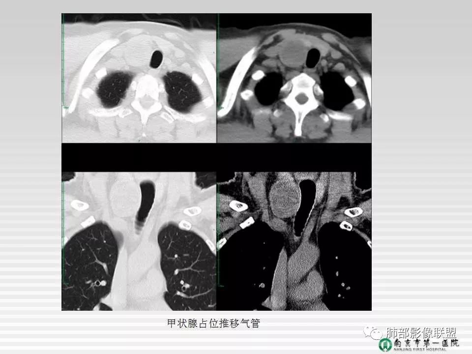 【PPT】胸片中的界与线——识别隐匿者与伪装者