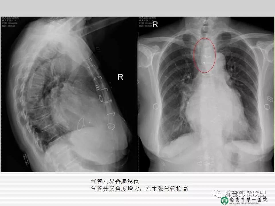 【PPT】胸片中的界与线——识别隐匿者与伪装者