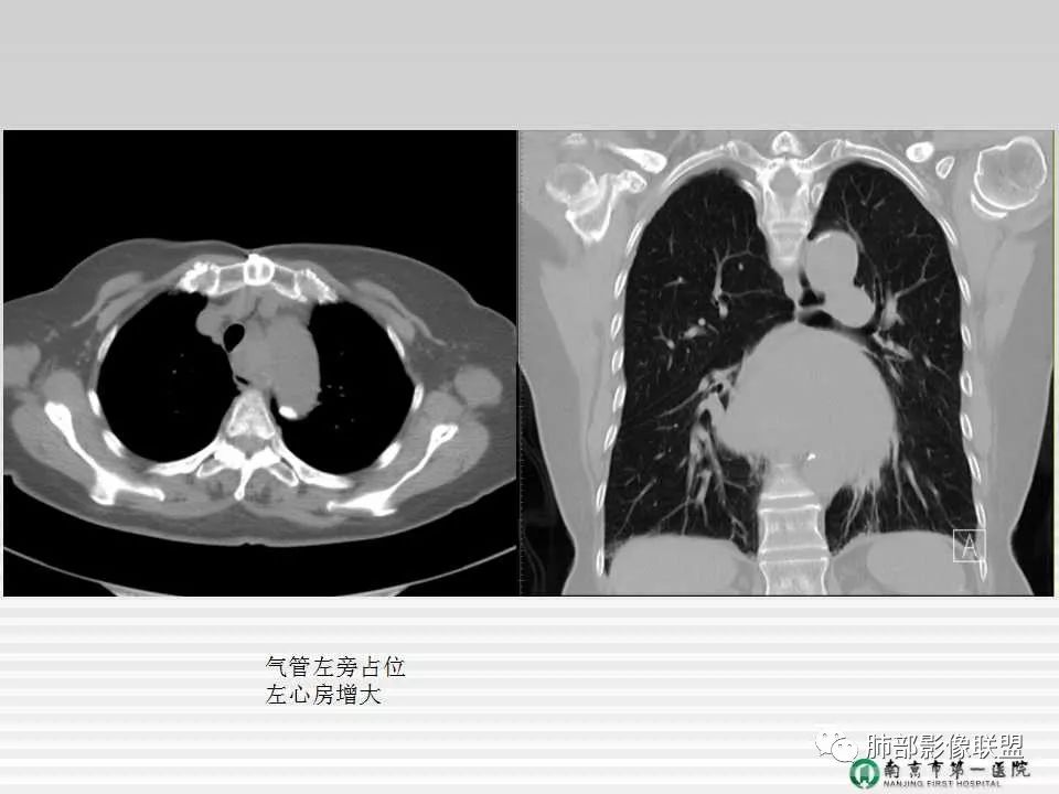 【PPT】胸片中的界与线——识别隐匿者与伪装者