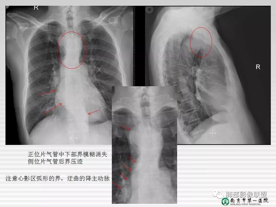 【PPT】胸片中的界与线——识别隐匿者与伪装者