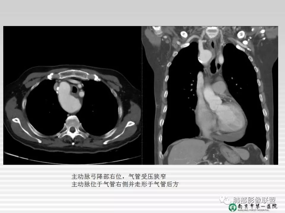 【PPT】胸片中的界与线——识别隐匿者与伪装者