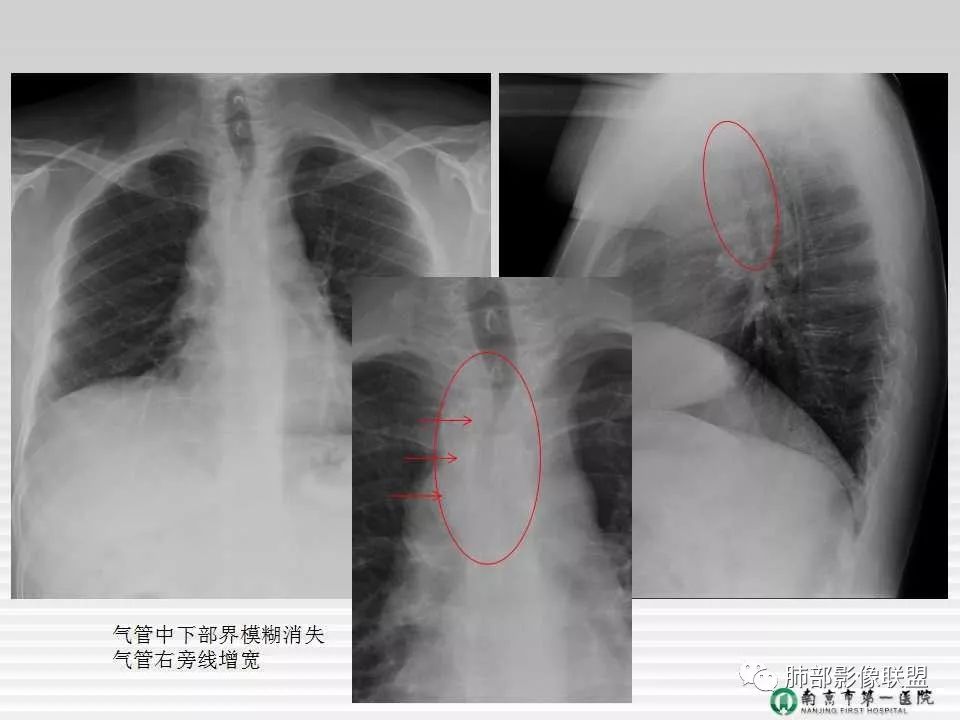 【PPT】胸片中的界与线——识别隐匿者与伪装者