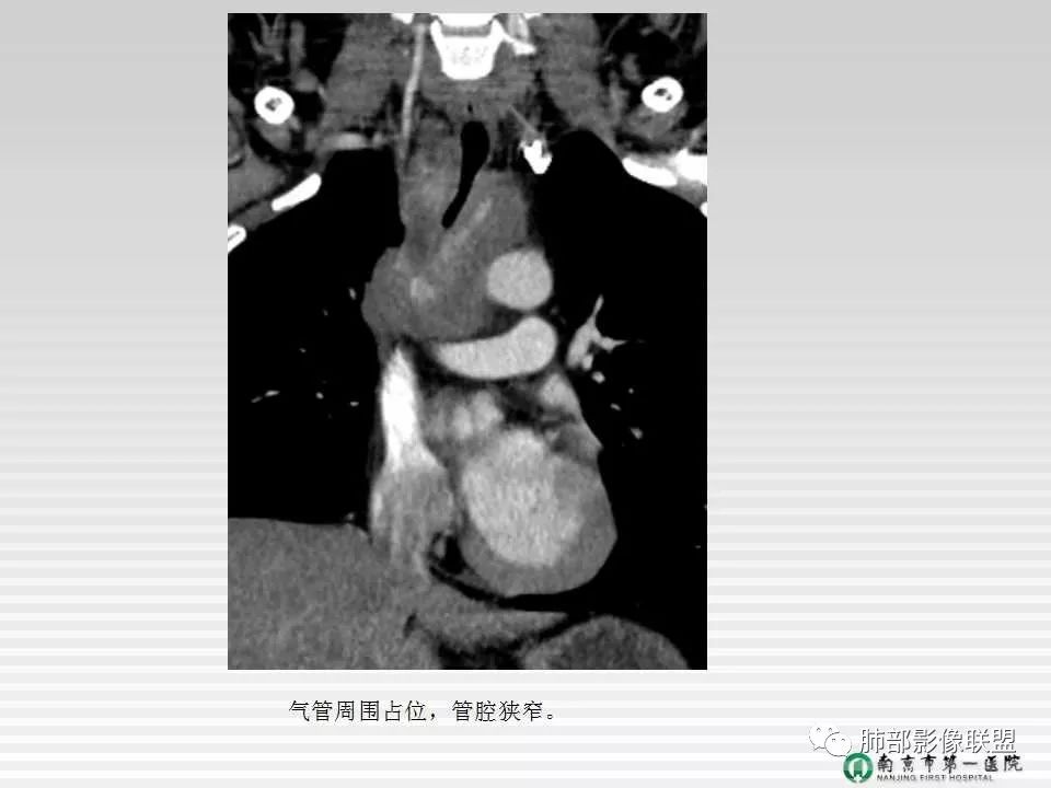 【PPT】胸片中的界与线——识别隐匿者与伪装者