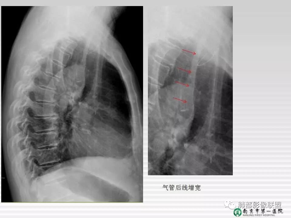 【PPT】胸片中的界与线——识别隐匿者与伪装者