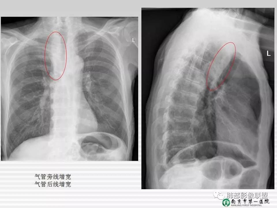 【PPT】胸片中的界与线——识别隐匿者与伪装者