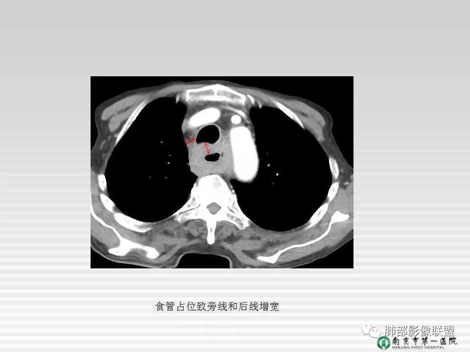 【PPT】胸片中的界与线——识别隐匿者与伪装者