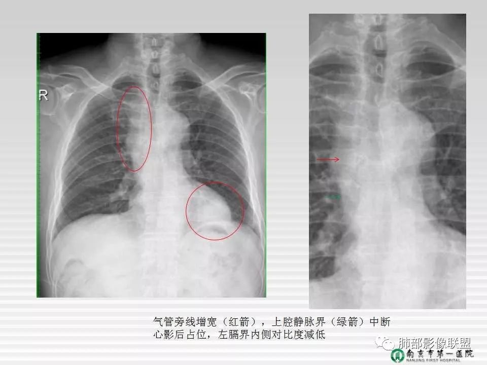 【PPT】胸片中的界与线——识别隐匿者与伪装者