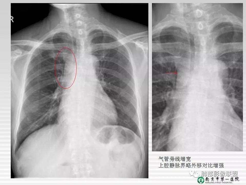 【PPT】胸片中的界与线——识别隐匿者与伪装者