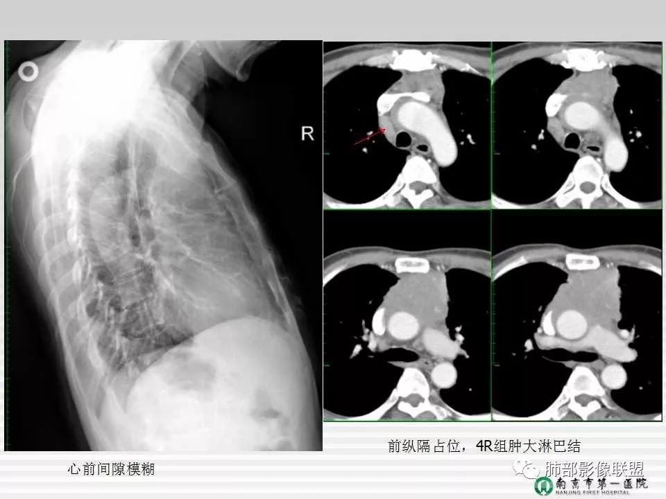 【PPT】胸片中的界与线——识别隐匿者与伪装者