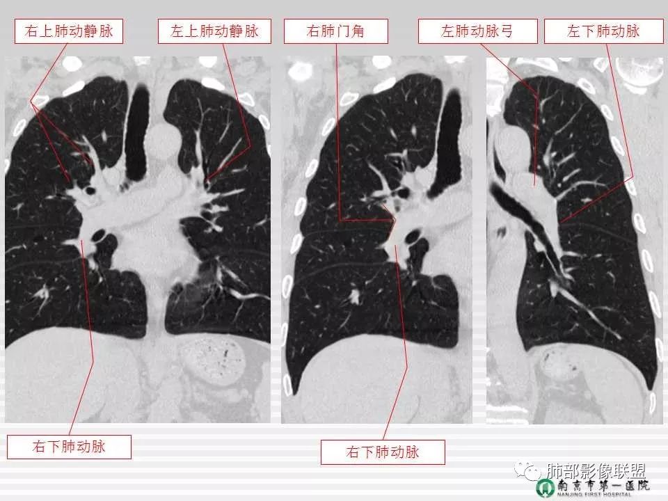 【PPT】胸片中的界与线——识别隐匿者与伪装者