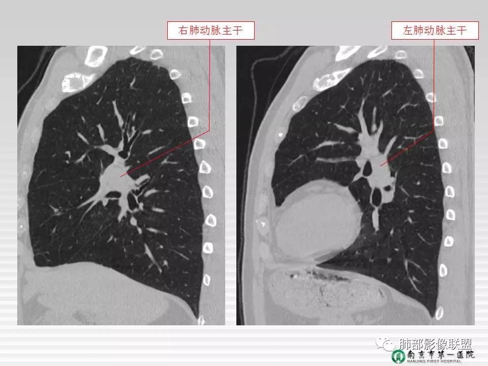 【PPT】胸片中的界与线——识别隐匿者与伪装者