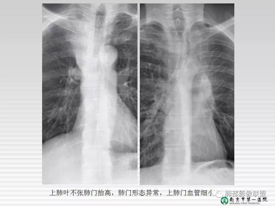 【PPT】胸片中的界与线——识别隐匿者与伪装者