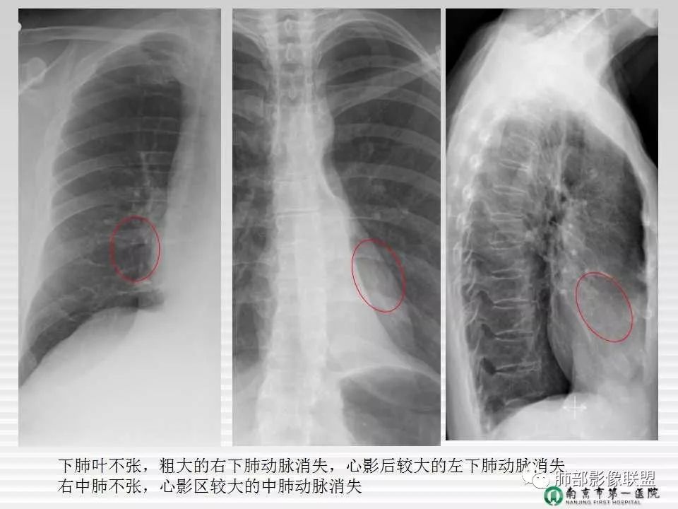 【PPT】胸片中的界与线——识别隐匿者与伪装者