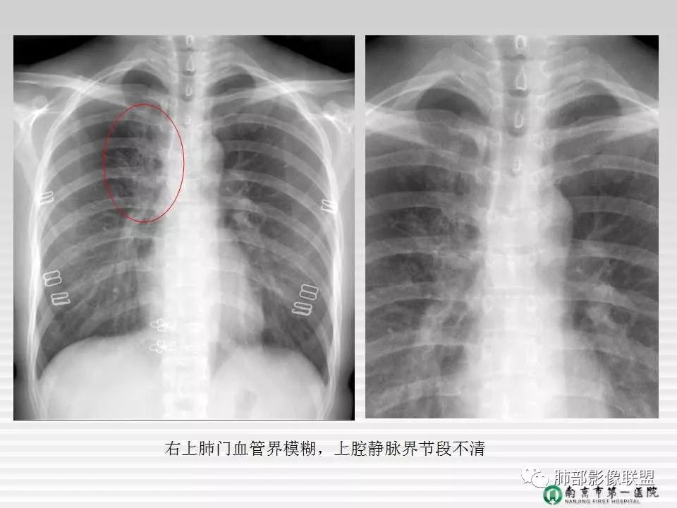 【PPT】胸片中的界与线——识别隐匿者与伪装者