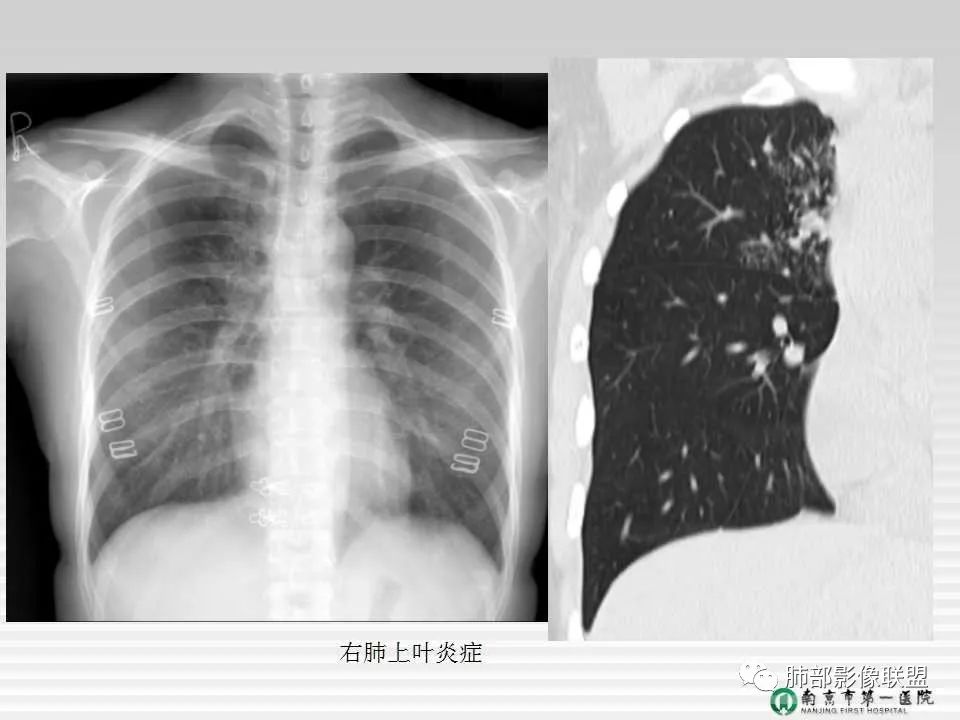【PPT】胸片中的界与线——识别隐匿者与伪装者