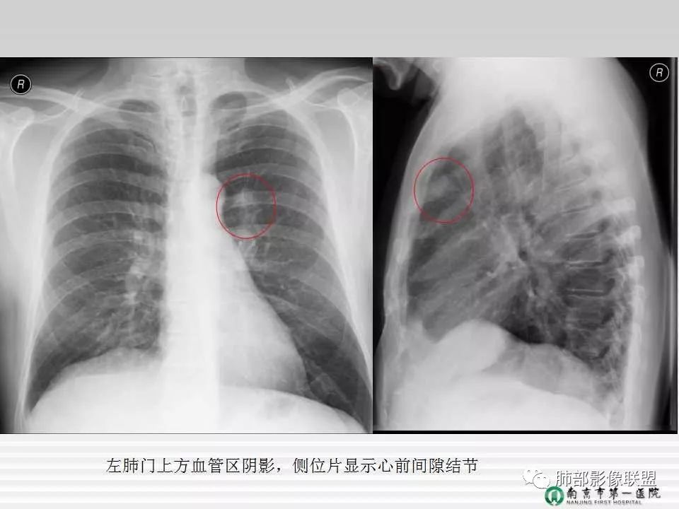 【PPT】胸片中的界与线——识别隐匿者与伪装者