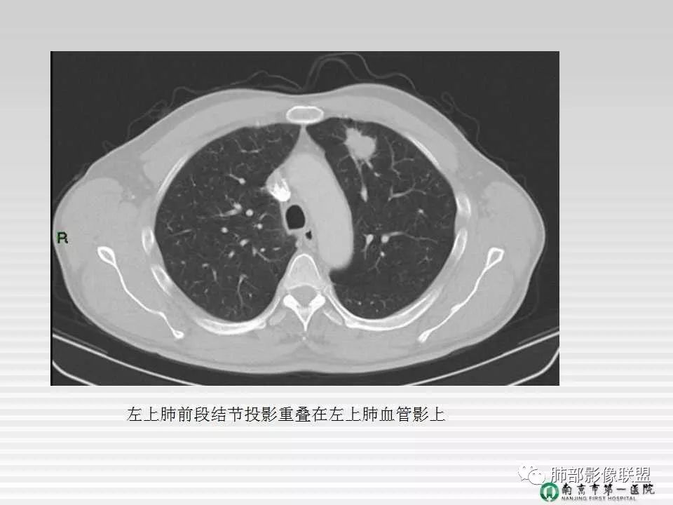 【PPT】胸片中的界与线——识别隐匿者与伪装者