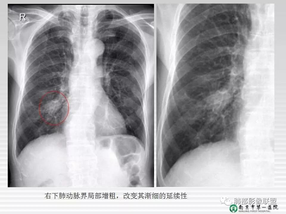 【PPT】胸片中的界与线——识别隐匿者与伪装者