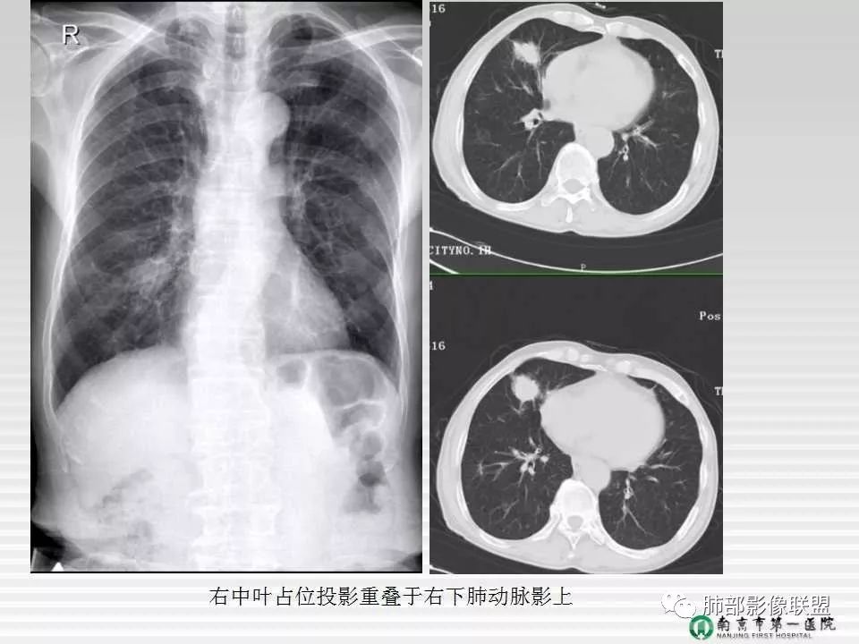 【PPT】胸片中的界与线——识别隐匿者与伪装者