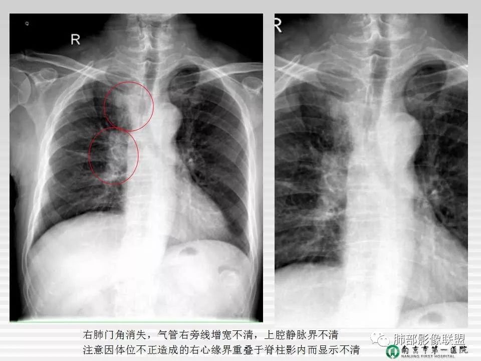 【PPT】胸片中的界与线——识别隐匿者与伪装者