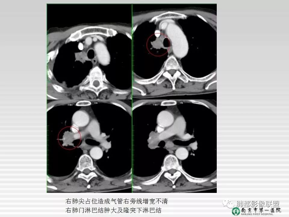 【PPT】胸片中的界与线——识别隐匿者与伪装者