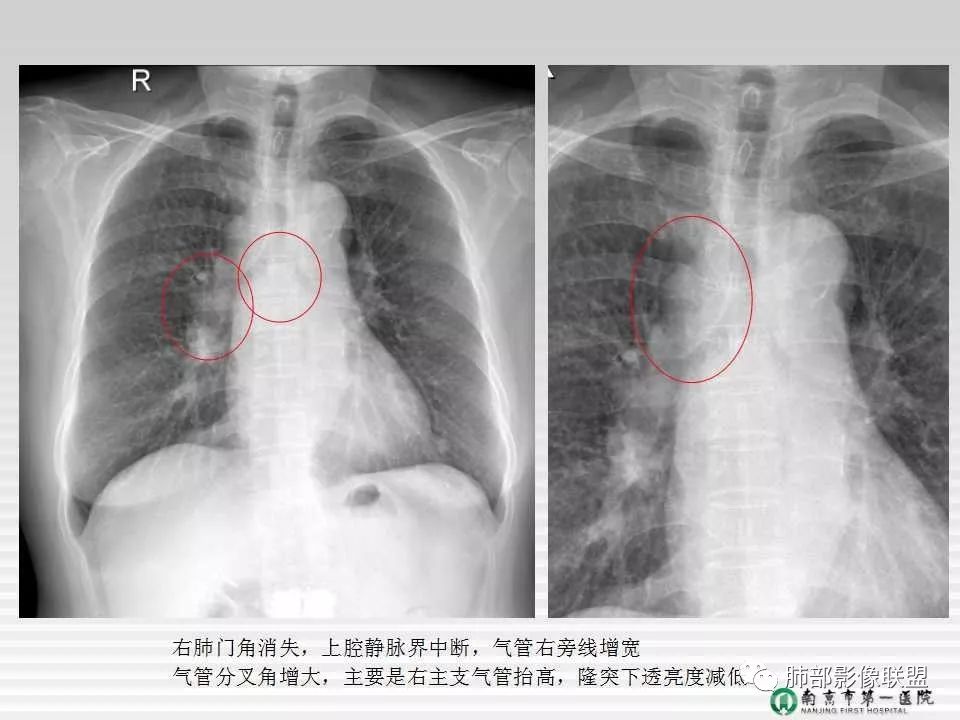 【PPT】胸片中的界与线——识别隐匿者与伪装者