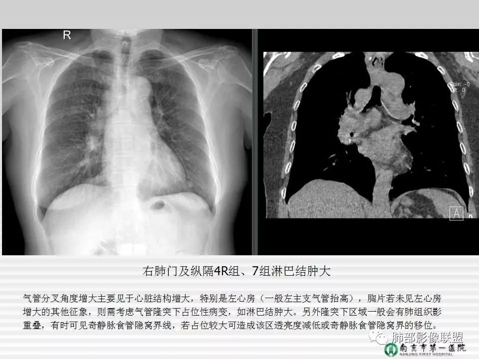 【PPT】胸片中的界与线——识别隐匿者与伪装者
