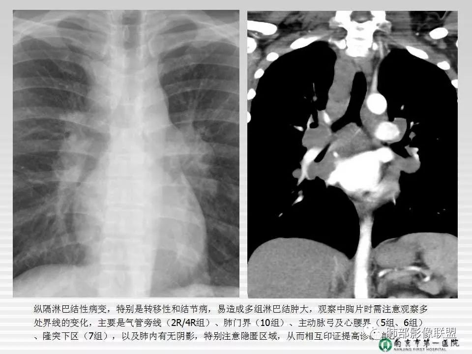 【PPT】胸片中的界与线——识别隐匿者与伪装者