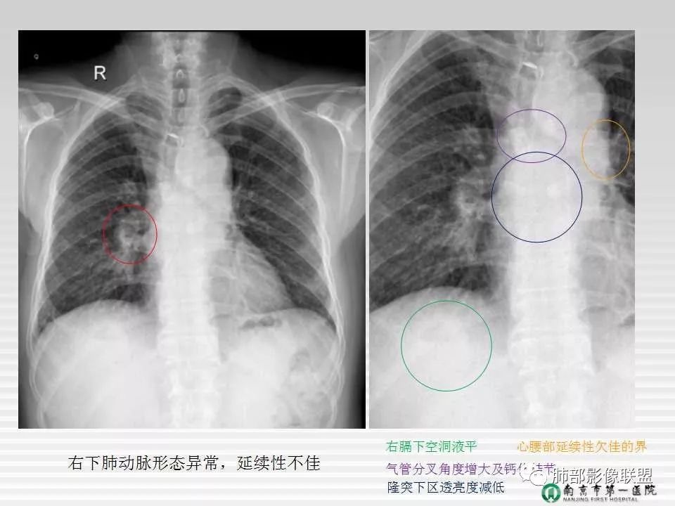 【PPT】胸片中的界与线——识别隐匿者与伪装者
