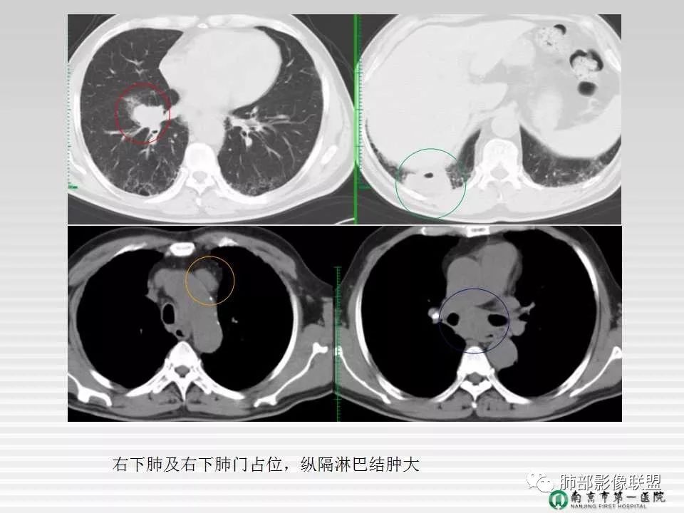 【PPT】胸片中的界与线——识别隐匿者与伪装者