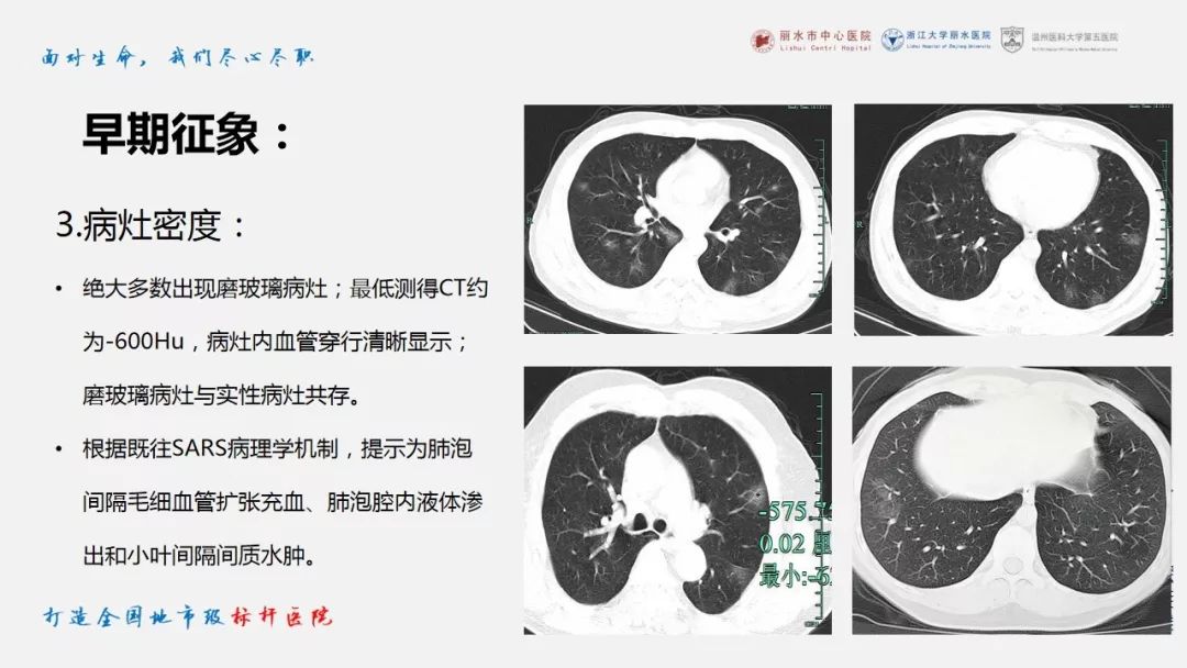 【PPT】新冠肺炎CT早期征象与临床基础及鉴别诊断