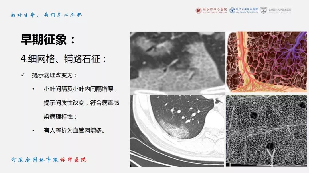 【PPT】新冠肺炎CT早期征象与临床基础及鉴别诊断