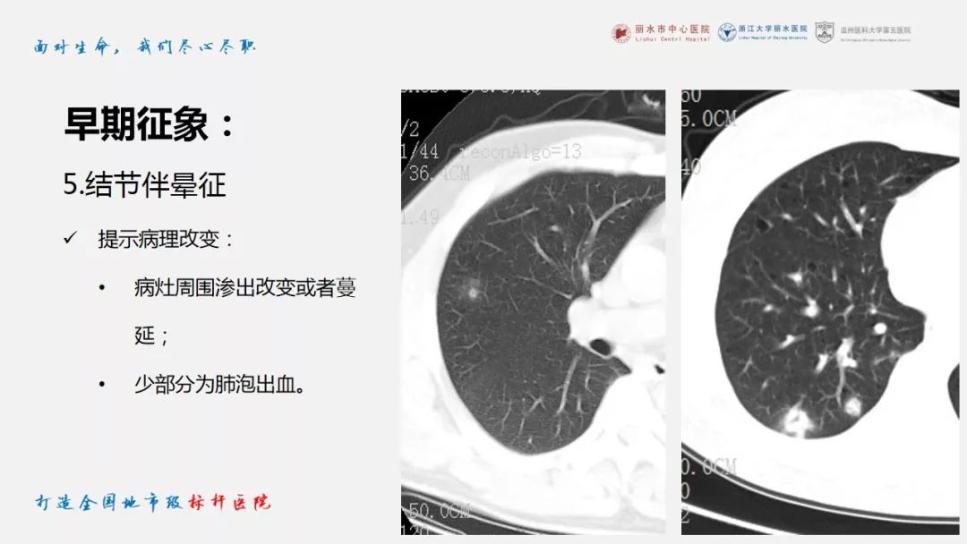 【PPT】新冠肺炎CT早期征象与临床基础及鉴别诊断